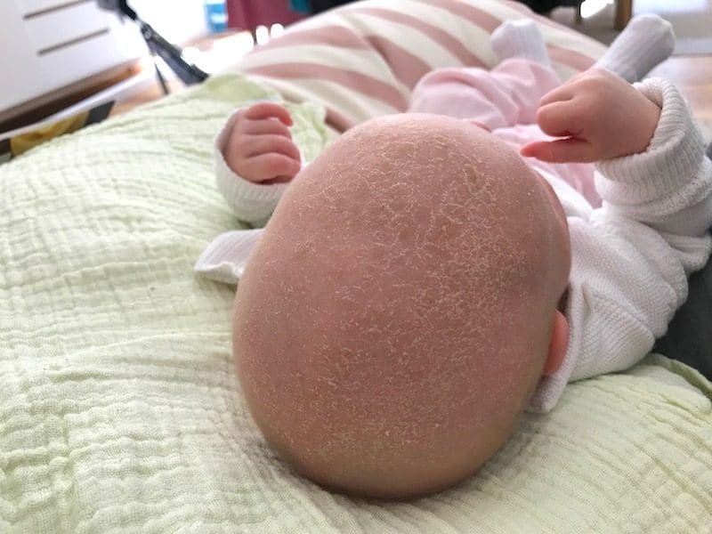 Tipp gegen Kopfgneis auch auf den Augenbrauen beim Baby: Muttermilch! | mehr Infos auf Mamaskind.de